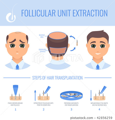 Transplantation with FUE in men 42856259