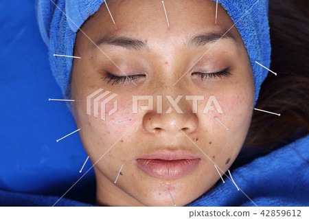 Hand Perform Medical professional acupuncture 42859612