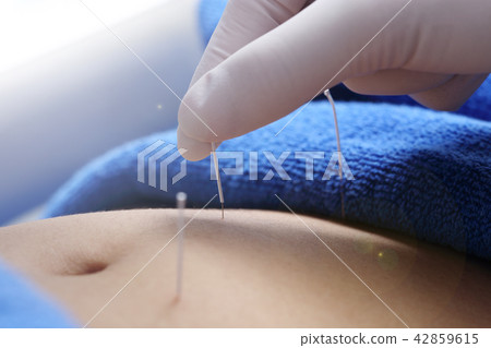 Hand Perform Medical professional acupuncture Hand Perform Medical professional acupuncture 42859615