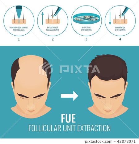 FUE hair loss treatment 42878071