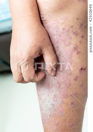 Close up a men is scratching their legs Close up a men is scratching their legs 42938649