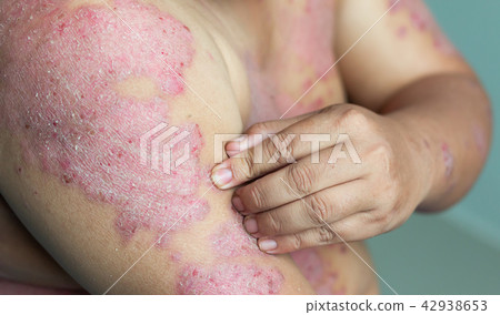 Diseases caused by abnormalities of the lymph Diseases caused by abnormalities of the lymph 42938653