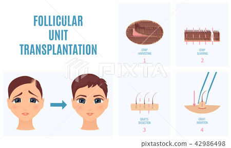 FUT treatment for women FUT treatment for women 42986498