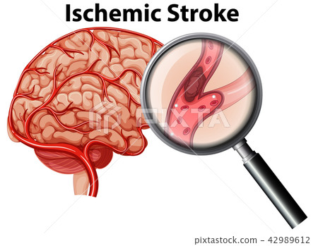 Magnified Ischemic stroke concept 42989612