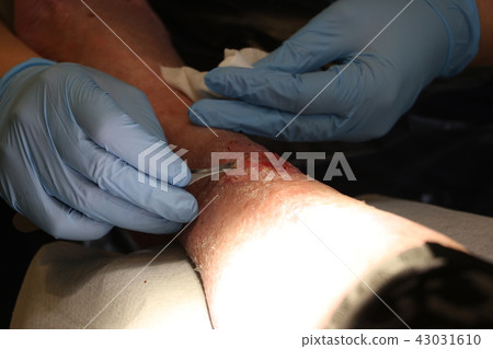 Wound on the leg Wound on the leg 43031610