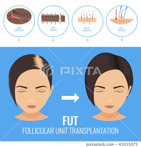 FUT treatment for women FUT treatment for women 43033075