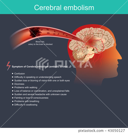 Cerebral embolism. Anatomy body, Health care. 43050127