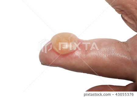 Burns on finger 43055376