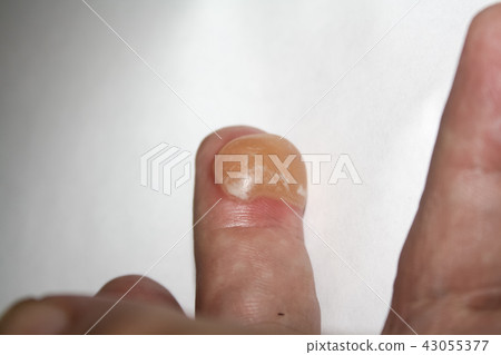 Burns on finger 43055377