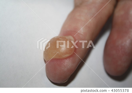 Burns on finger 43055378