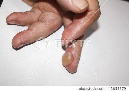 Burns on finger 43055379