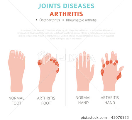 Joints diseases. Arthritis symptoms infographic Joints diseases. Arthritis symptoms infographic 43070553