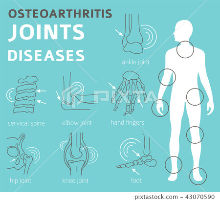 Joints diseases.Osteoarthritis infographic Joints diseases.Osteoarthritis infographic 43070590