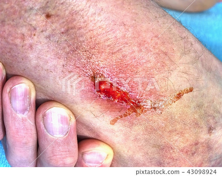 Doctors hand healing burned skin. Injured  place 43098924