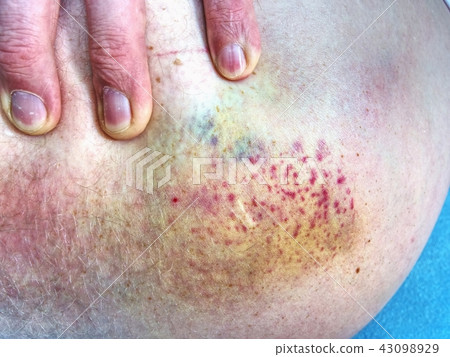 Bruised wound injury on human body. Injured plaxe Bruised wound injury on human body. Injured plaxe 43098929