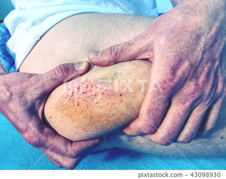 Fresh bruise on white skin. Purple bruise body 43098930