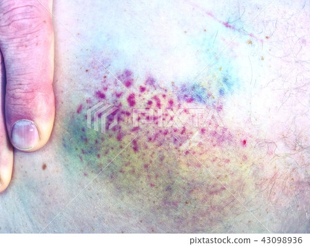 Hand embracing injured leg with painful hematoma 43098936