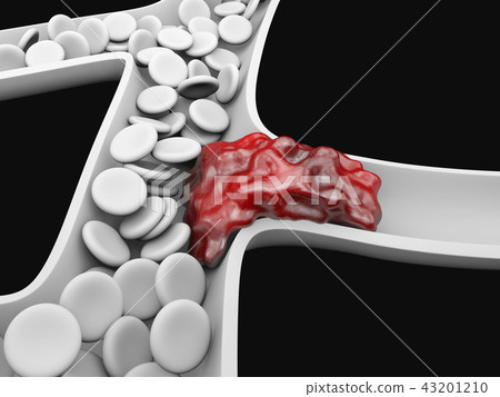 Deep Vein Thrombosis or Blood Clots. Embolism. Deep Vein Thrombosis or Blood Clots. Embolism. 43201210