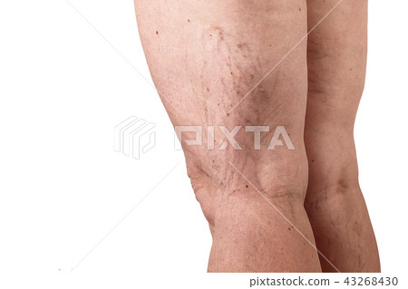 the disease varicose veins on a womans legs. white background the disease varicose veins on a womans legs. white background 43268430