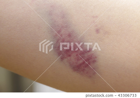 Injury bruise bruise image Injury bruise bruise image 43306733