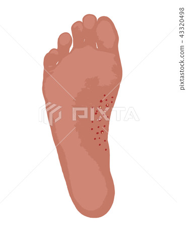 Small water drop type athlete's foot 43320498