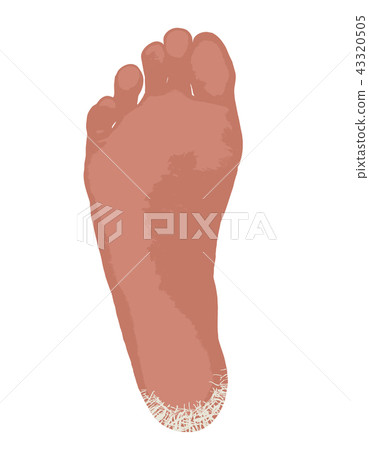 Hyperkeratotic athlete's foot 43320505