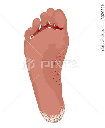 Three types of athlete's foot 43320506