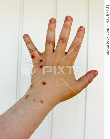 Burn hand. Burn hand. 43367431