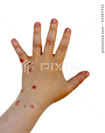 Burn hand. Burn hand. 43367432