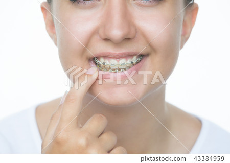 Face of a young woman with braces on her teeth . Face of a young woman with braces on her teeth . 43384959