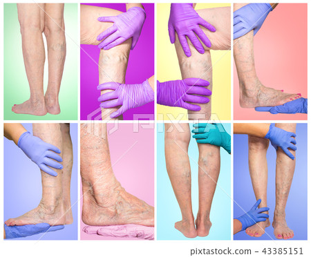Lower limb vascular examination because suspect of venous insufficiency. 43385151