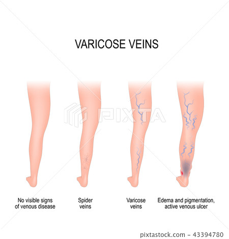 l carnitina în varicoza tahicardia i venele varicoase