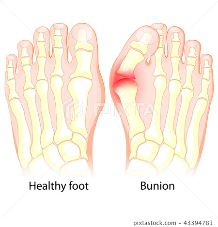 Bunion. Human anatomy. Skeleton Bunion. Human anatomy. Skeleton 43394781