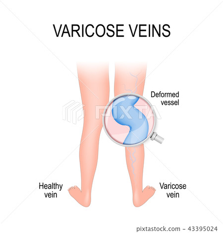 varicose vein and normal vein varicose vein and normal vein 43395024