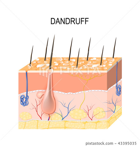 Dandruff. seborrheic dermatitis Dandruff. seborrheic dermatitis 43395035