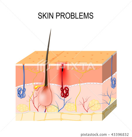 Skin problems. Clogged pores 43396832