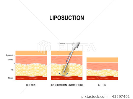 liposuction procedure. Before and after 43397401