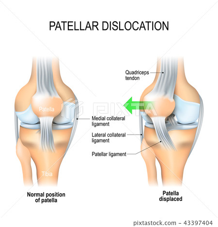 Patellar dislocation Patellar dislocation 43397404
