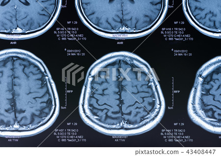 brain ct scan 43408447