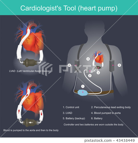 A Cardiologist  Tool heart pump 43438449
