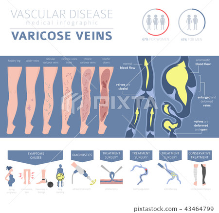 Vascular diseases. Varicose veins infographic Vascular diseases. Varicose veins infographic 43464799