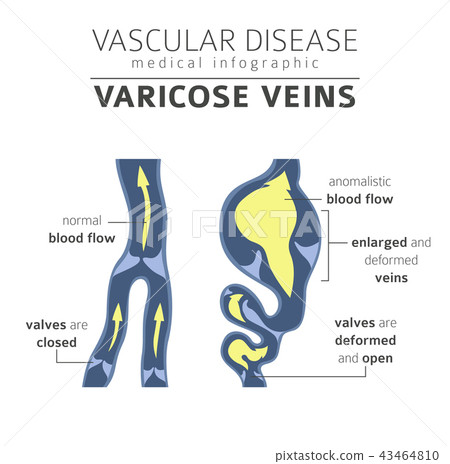 Vascular diseases. Varicose veins infographic Vascular diseases. Varicose veins infographic 43464810