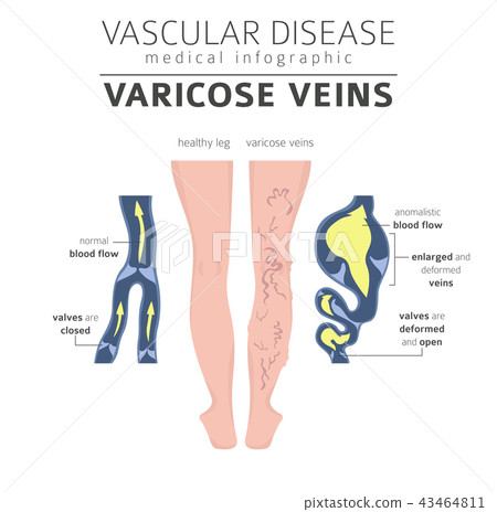 Vascular diseases. Varicose veins infographic 43464811