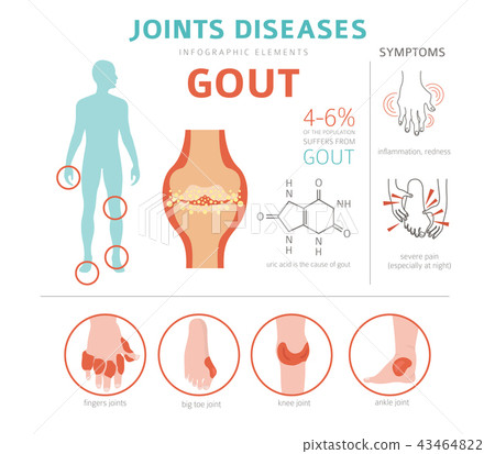 Joints diseases. Gout infographic - Stock Illustration [43464822] - PIXTA