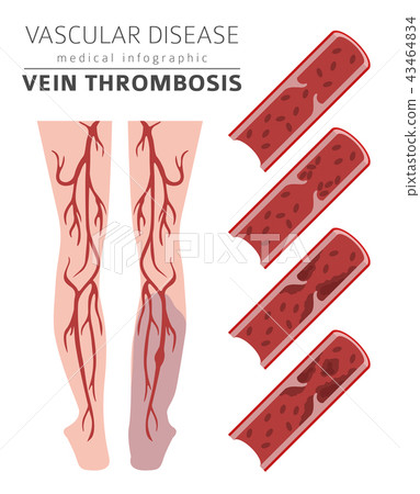 Vascular diseases. Vein thrombosis infographic Vascular diseases. Vein thrombosis infographic 43464834