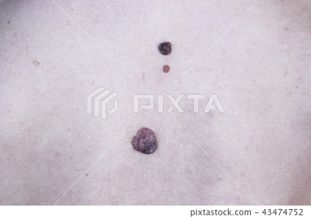 Big moles on back of woman close up 43474752