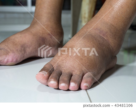 The feet of people with diabetes, dull and swollen 43481106
