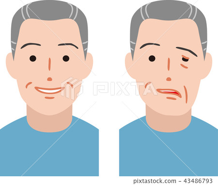 Facial nerve palsy Facial nerve palsy 43486793