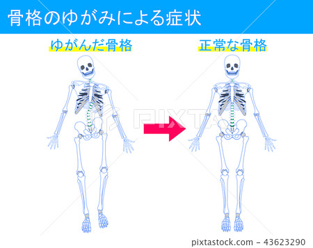 症狀4由於骨骼扭曲 症狀4由於骨骼扭曲 43623290