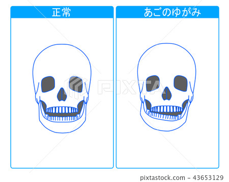 Comparison of normality and jaw distortion 2 Comparison of normality and jaw distortion 2 43653129